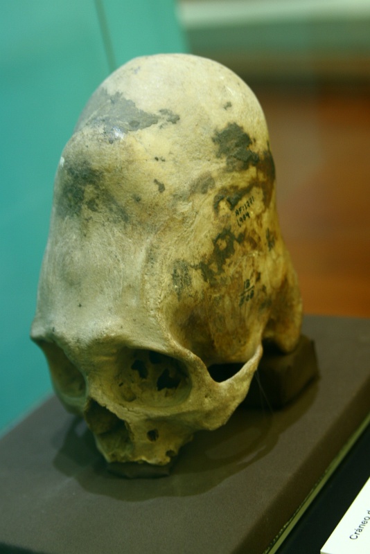 IMG_8843.JPG - Skull that underwent cranioplasty using ropes and pads applied over time.  Some pre-Incan cultures (like the Paracas) were adept at cranioplasty and cranial trepanation - the practice was reserved for those of the noble class.  Inside the National Museum of Archaeology.